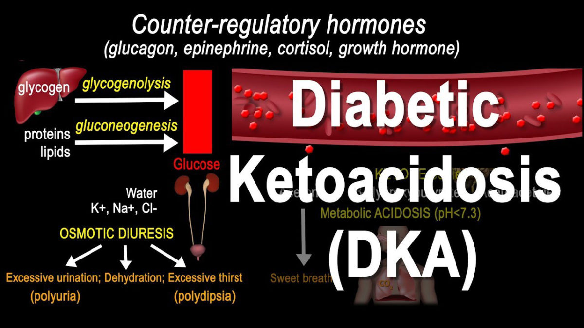 Dka Ss Diabetic Ketoacidosis (DKA) - Vidan Diagnostics