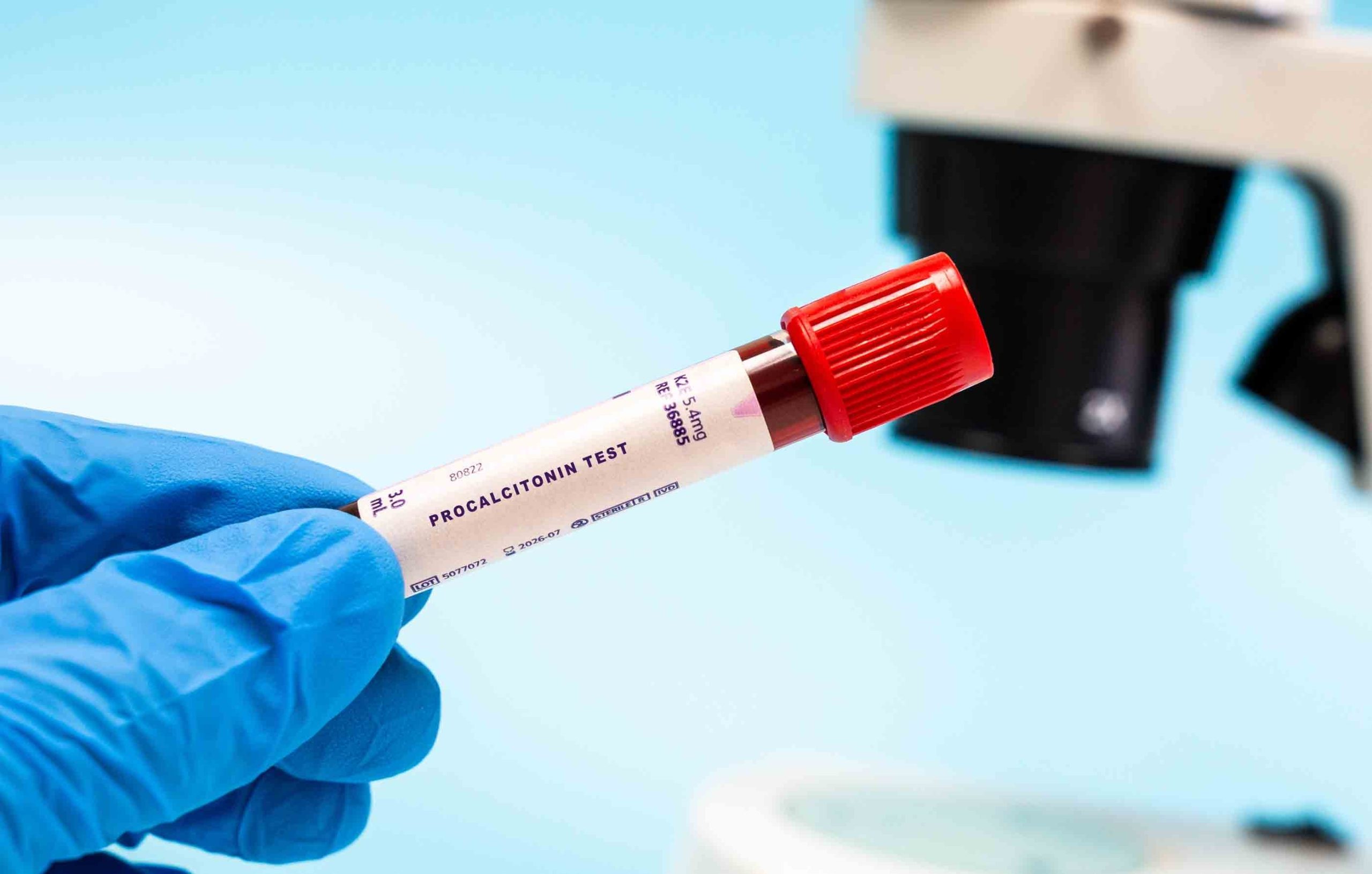 Procalcitonin,Test,Blood,Samples,In,Test,Tube,For,Microbiological,Research